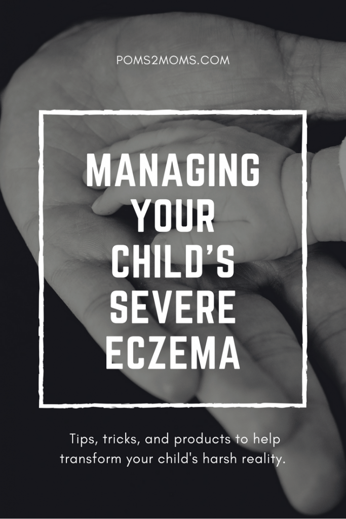 manage-severe-eczema