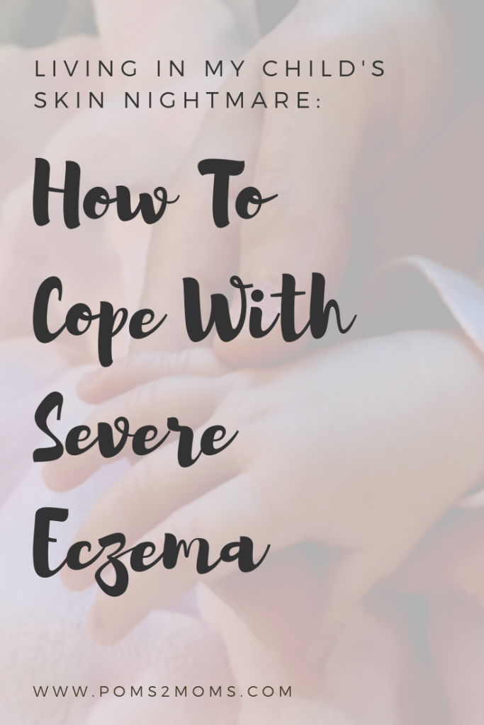 manage-severe-eczema